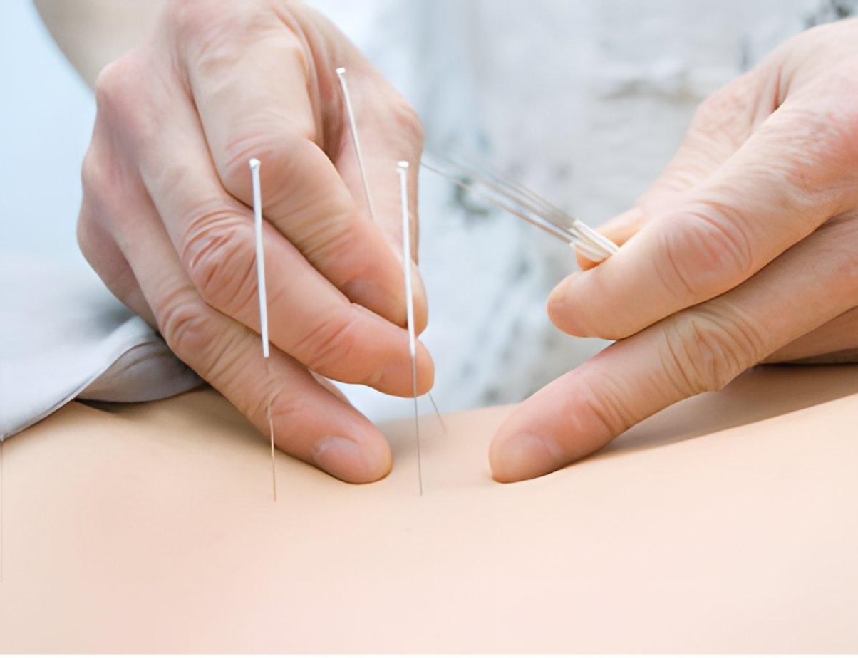 Acupuncture needles in place during treatment